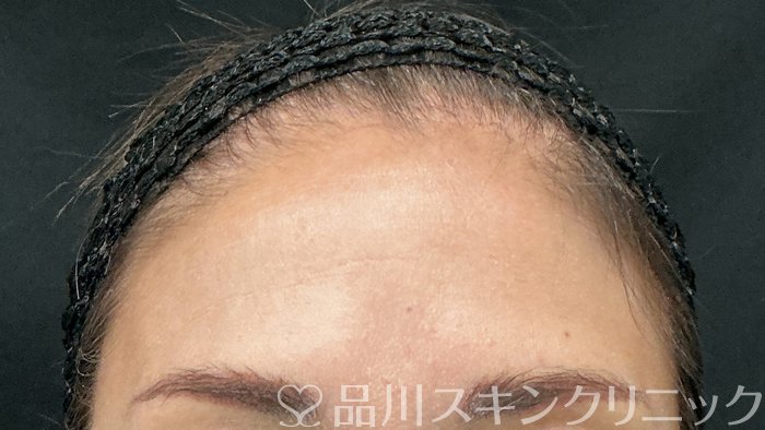 症例NO.75222のBEFORE写真