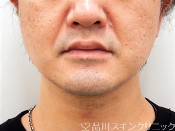 症例NO.52227のBEFORE写真