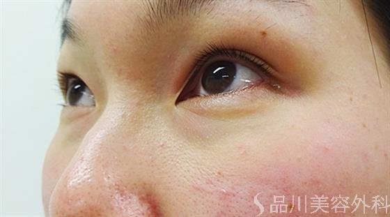 症例NO.36176のBEFORE写真