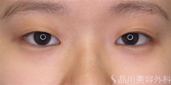 症例NO.48053のBEFORE写真
