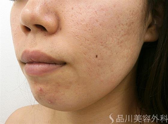 症例NO.23672のBEFORE写真