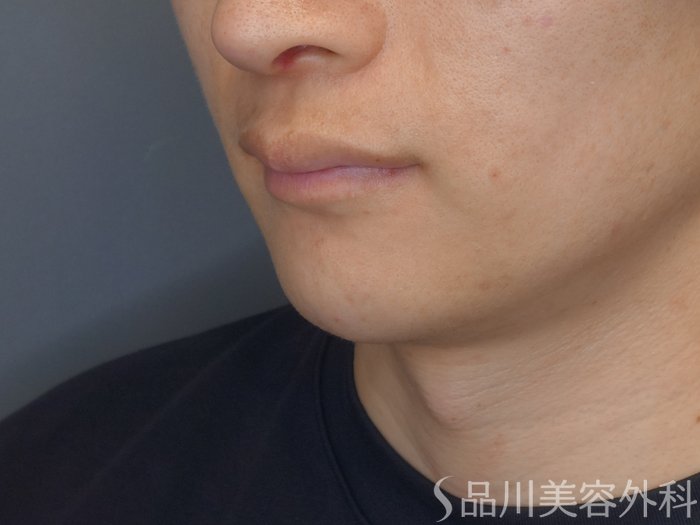 症例NO.70250のBEFORE写真