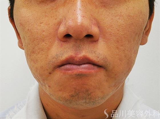 症例NO.30849のBEFORE写真