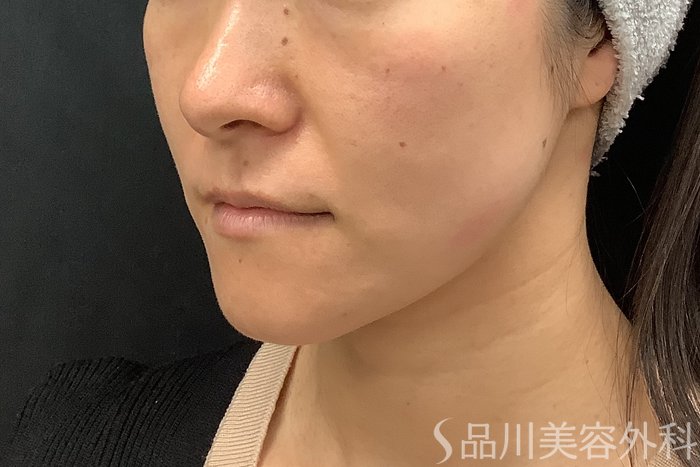 症例NO.71545のBEFORE写真