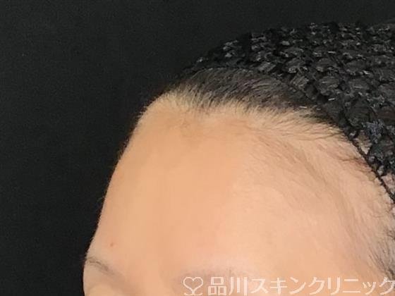 症例NO.61118のBEFORE写真