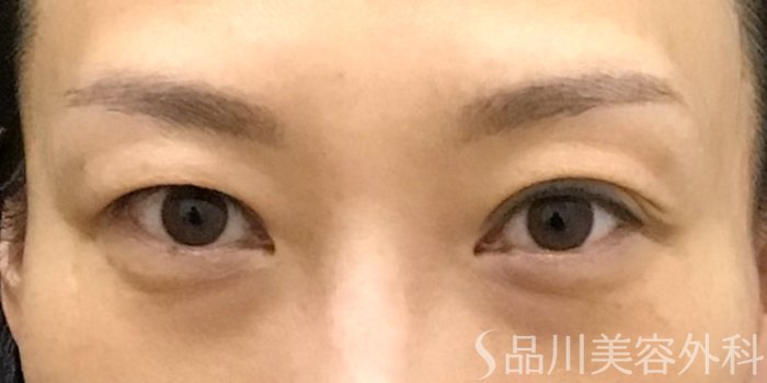症例NO.70242のBEFORE写真