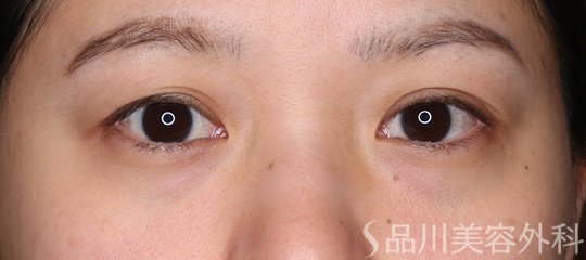 症例NO.74715のBEFORE写真