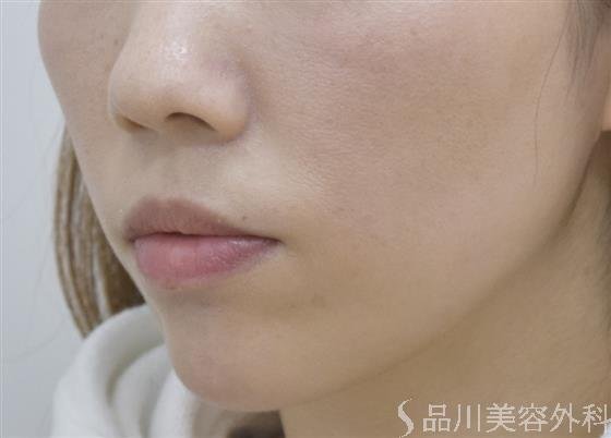 症例NO.47340のAFTER写真