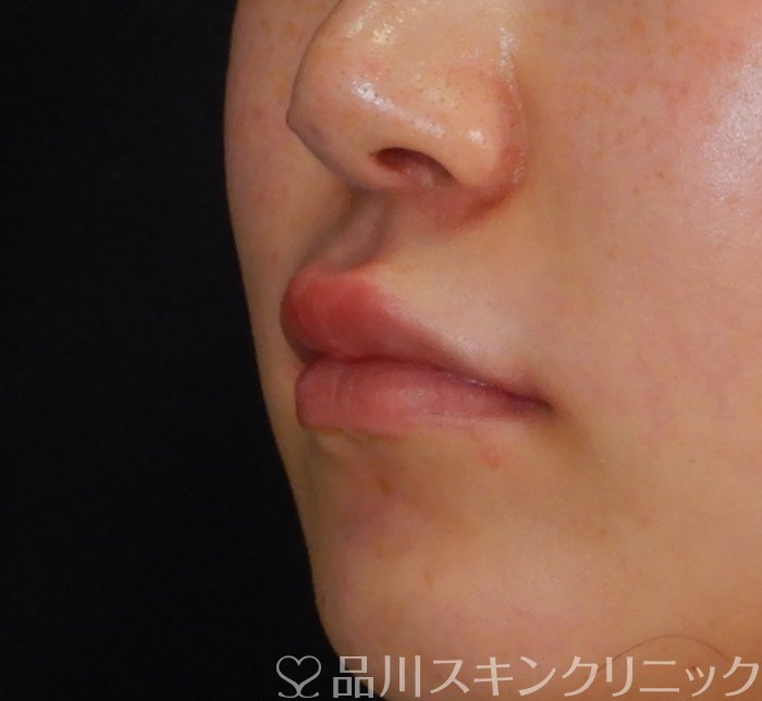 症例NO.66221のAFTER写真