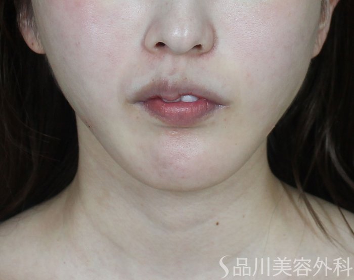 症例NO.73434のAFTER写真