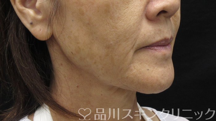 症例NO.71372のBEFORE写真