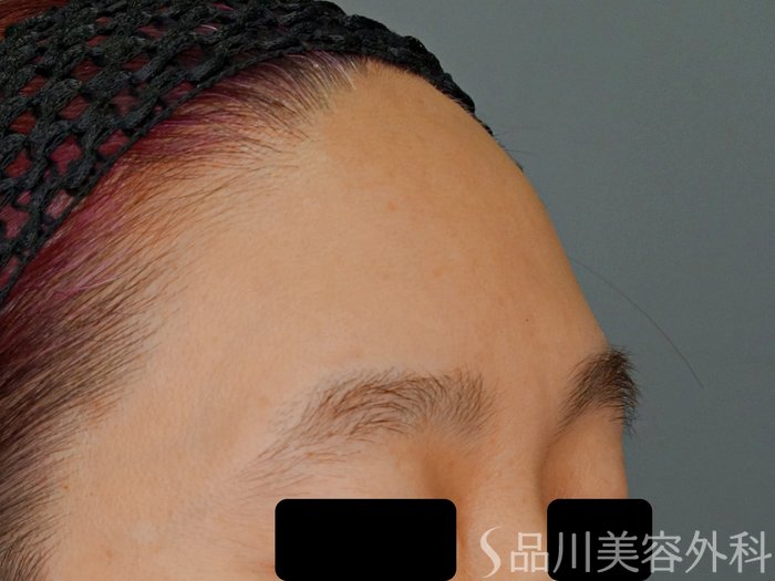 症例NO.70251のBEFORE写真