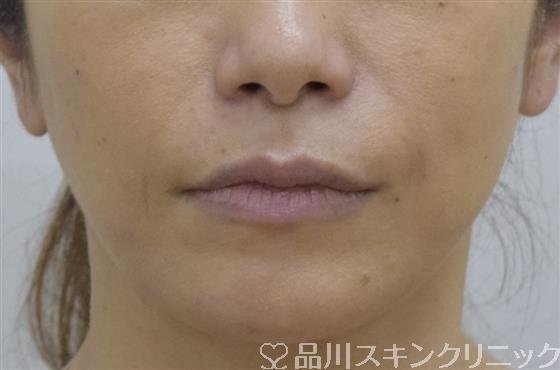 症例NO.53406のAFTER写真