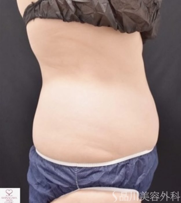症例NO.68574のBEFORE写真