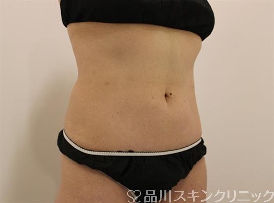 症例NO.49451のAFTER写真