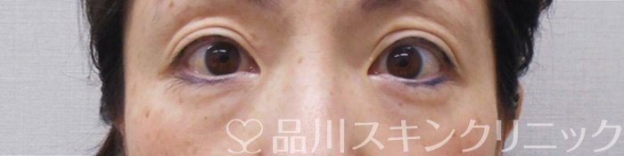 症例NO.69974のBEFORE写真