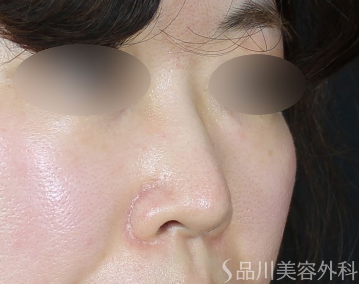 症例NO.71606のBEFORE写真