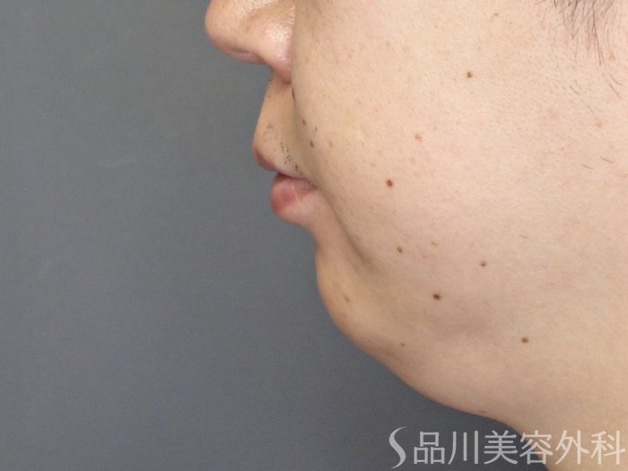 症例NO.68959のBEFORE写真