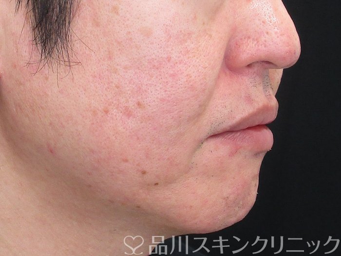 症例NO.73263のBEFORE写真