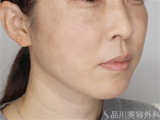 症例NO.51605のAFTER写真