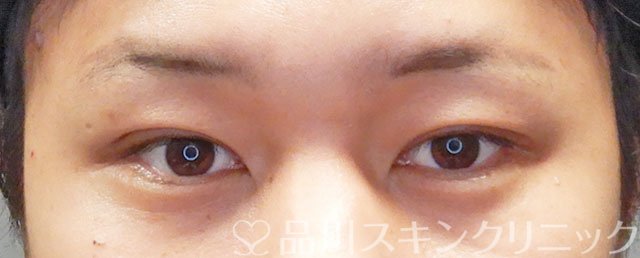 症例NO.74756のAFTER写真