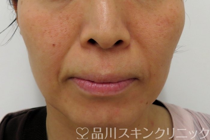 症例NO.74837のBEFORE写真