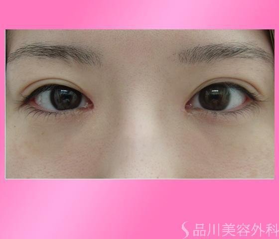 症例NO.14238のAFTER写真