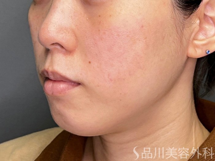 症例NO.74385のBEFORE写真