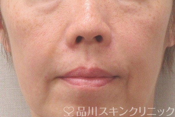 症例NO.73172のAFTER写真