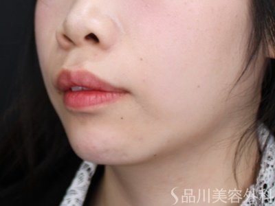 症例NO.72256のAFTER写真