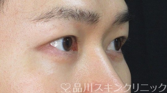 症例NO.71790のAFTER写真
