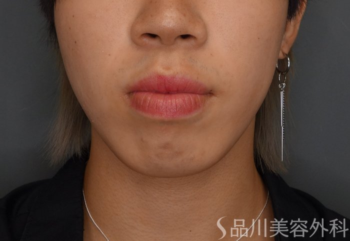 症例NO.75358のBEFORE写真