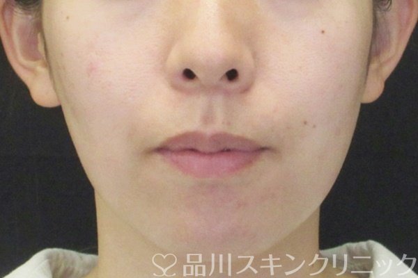 症例NO.64758のBEFORE写真