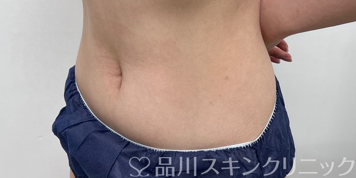 症例NO.69949のAFTER写真