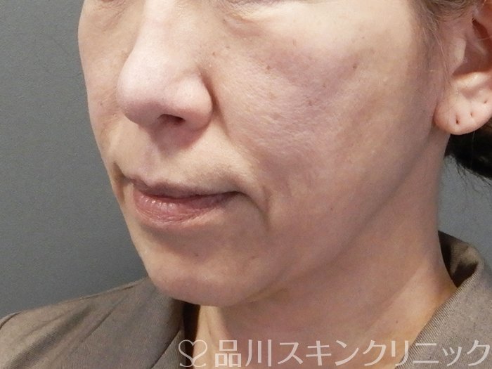 症例NO.73575のBEFORE写真