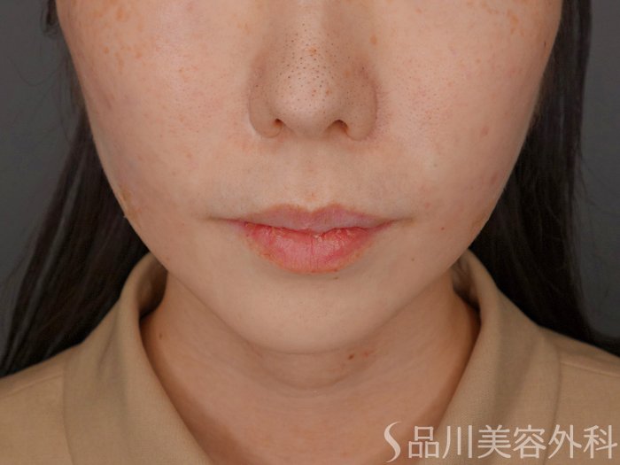 症例NO.62465のAFTER写真