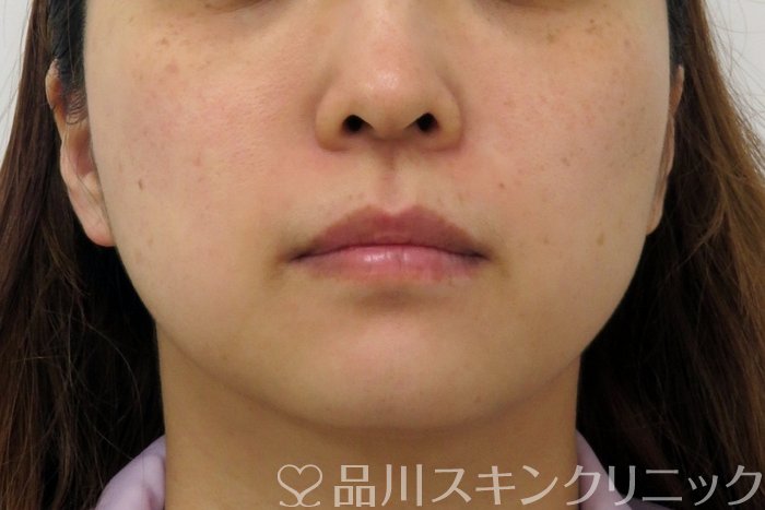 症例NO.74817のBEFORE写真