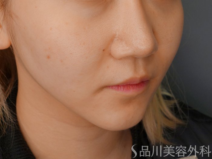 症例NO.73285のAFTER写真