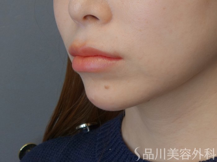 症例NO.72584のAFTER写真