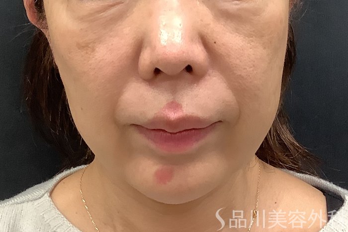 症例NO.65192のBEFORE写真