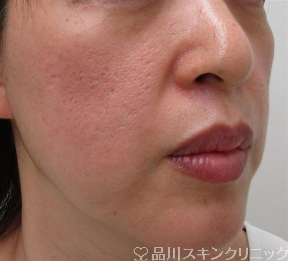 症例NO.30719のBEFORE写真