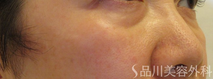 症例NO.70427のBEFORE写真