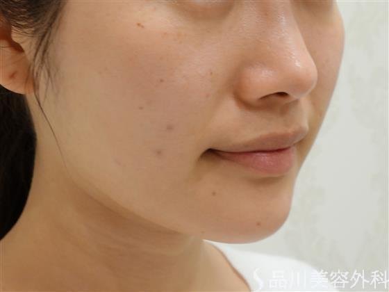 症例NO.47375のBEFORE写真