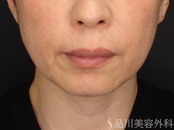 症例NO.73723のBEFORE写真