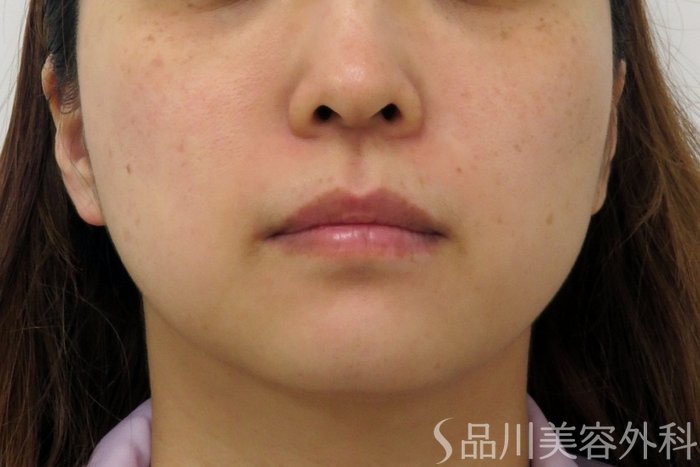 症例NO.74817のBEFORE写真