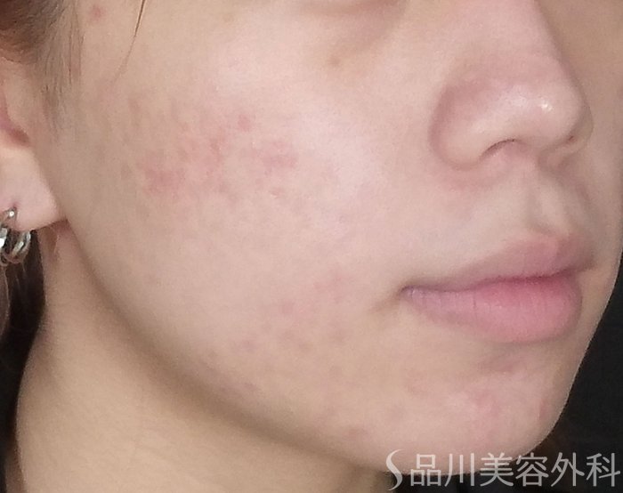 症例NO.72189のAFTER写真