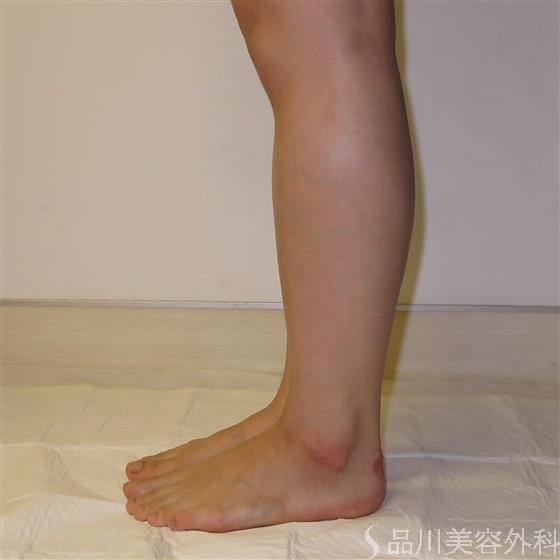症例NO.42432のBEFORE写真