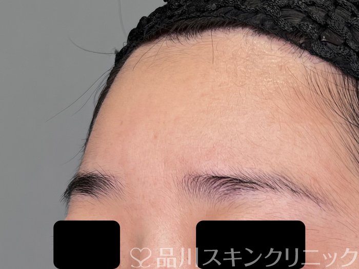 症例NO.70083のBEFORE写真