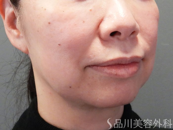 症例NO.73373のBEFORE写真