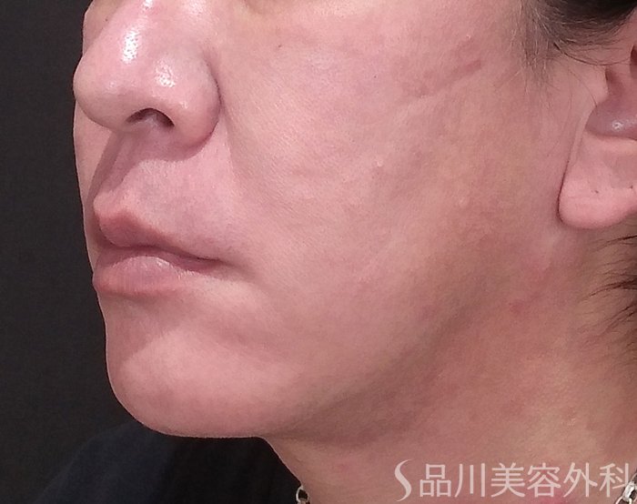 症例NO.69350のBEFORE写真